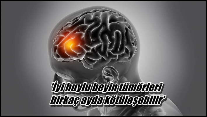 <’İyi huylu beyin tümörleri birkaç ayda kötüleşebilir’